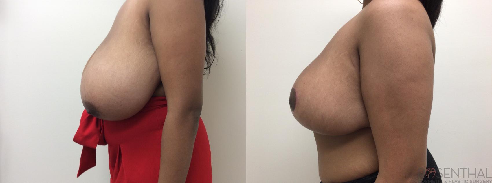 Before & After Breast Reduction Case 51 Left Side View in Boynton Beach, West Palm Beach, FL