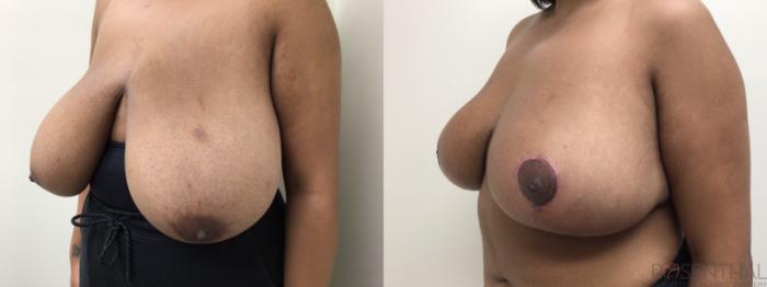 Before & After Breast Reduction Case 51 Right Oblique View in Boynton Beach, West Palm Beach, FL