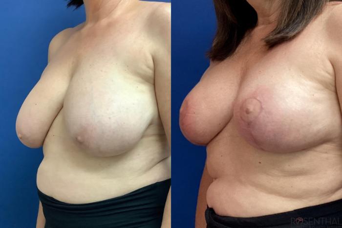 Before & After Breast Reduction Case 52 Left Oblique View in Boynton Beach, West Palm Beach, FL