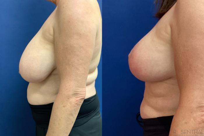 Before & After Breast Reduction Case 52 Left Side View in Boynton Beach, West Palm Beach, FL