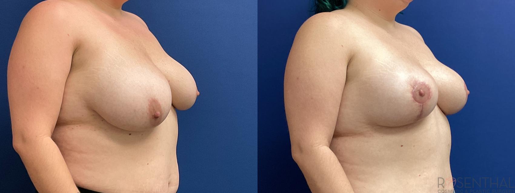 Before & After Breast Reduction Case 53 Right Oblique View in Boynton Beach, West Palm Beach, FL