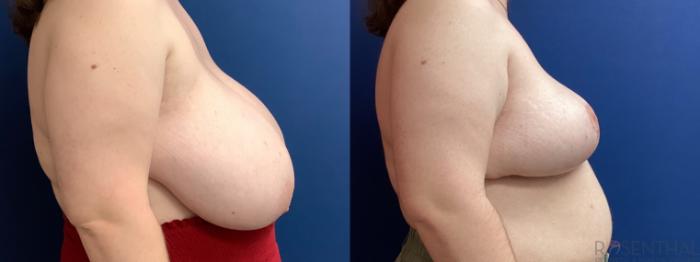 Before & After Breast Reduction Case 54 Right Side View in Boynton Beach, West Palm Beach, FL