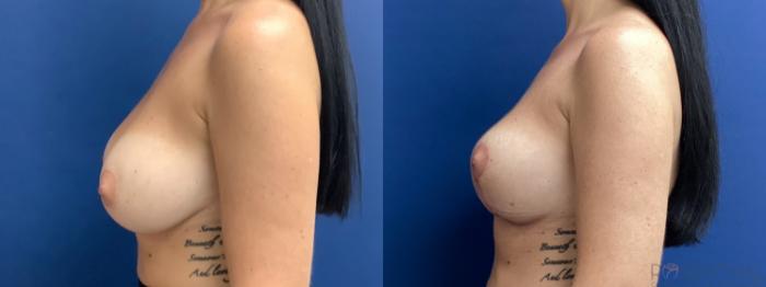 Before & After Breast Reduction Case 65 Left Side View in Boynton Beach, West Palm Beach, FL