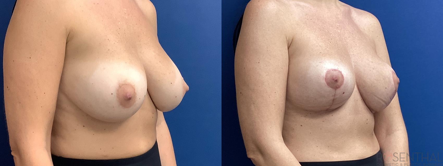 Before & After Breast Reduction Case 65 Right Oblique View in Boynton Beach, West Palm Beach, FL