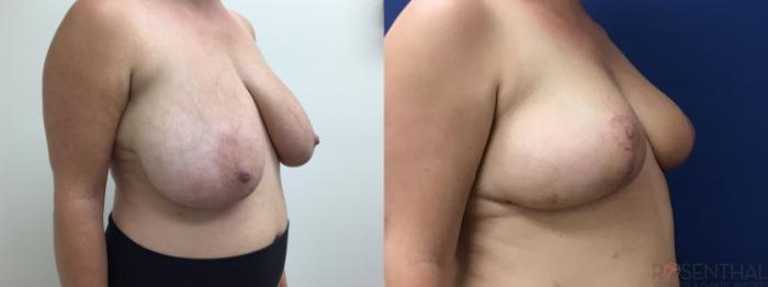 Before & After Breast Reduction Case 67 Right Oblique View in Boynton Beach, West Palm Beach, FL