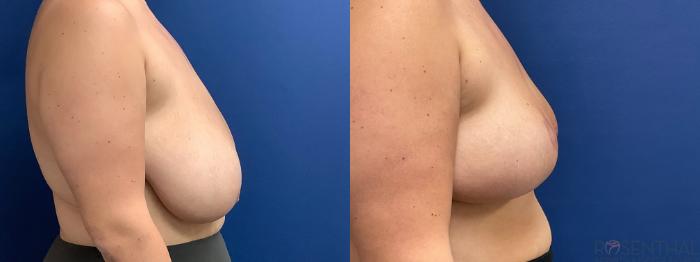 Before & After Breast Reduction Case 68 Right Side View in Boynton Beach, West Palm Beach, FL