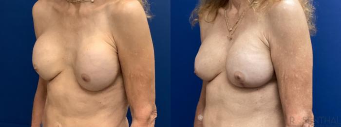 Before & After Breast Revision Case 75 Left Oblique View in Boynton Beach, West Palm Beach, FL