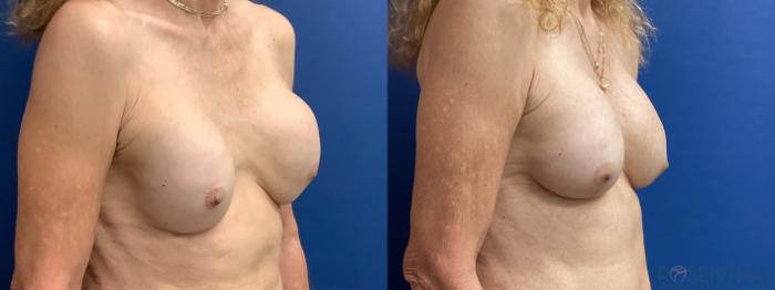 Before & After Breast Revision Case 75 Right Oblique View in Boynton Beach, West Palm Beach, FL