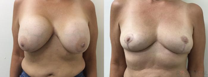 Before & After Breast Revision Case 76 Front View in Boynton Beach, West Palm Beach, FL