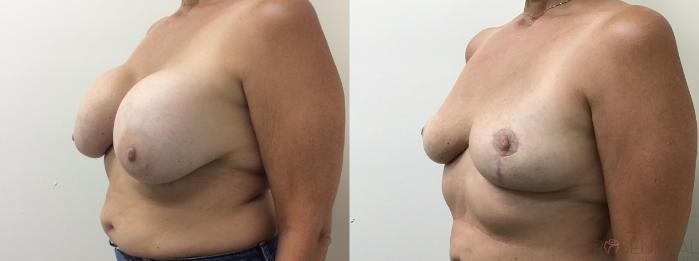 Before & After Breast Revision Case 76 Left Oblique View in Boynton Beach, West Palm Beach, FL