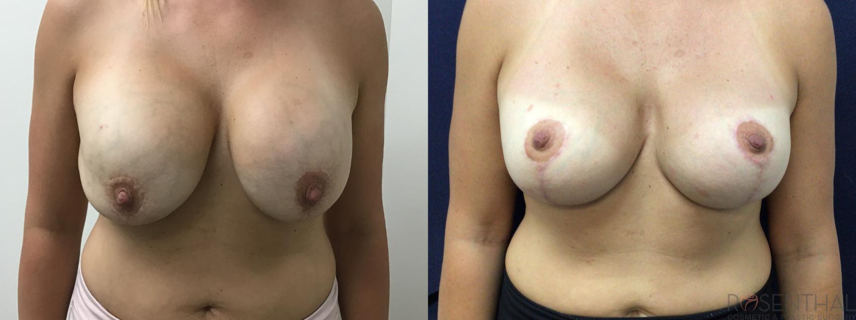 Before & After Breast Revision Case 77 Front View in Boynton Beach, West Palm Beach, FL