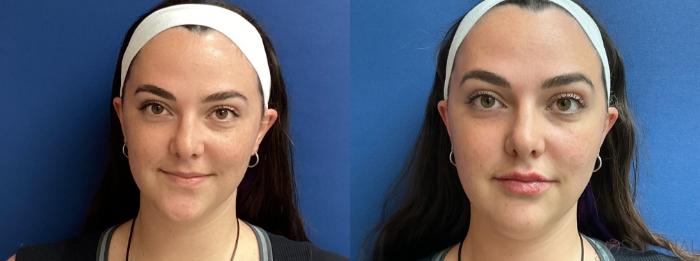Before & After Dermal Fillers Case 27 Front View in Boynton Beach, West Palm Beach, FL