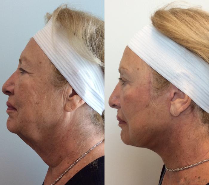 Before & After Facelift Case 16 Left Side View in Boynton Beach, West Palm Beach, FL