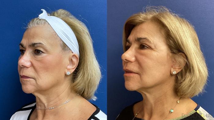 Before & After Facelift Case 35 Left Oblique View in Boynton Beach, West Palm Beach, FL