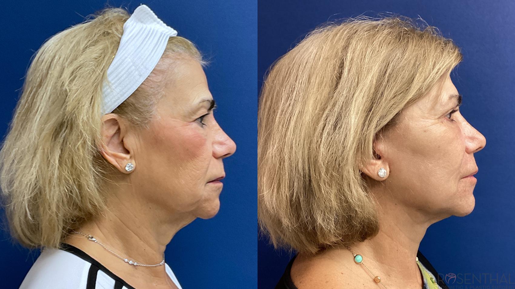 Before & After Facelift Case 35 Right Side View in Boynton Beach, West Palm Beach, FL