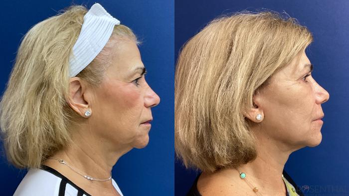 Before & After Facelift Case 35 Right Side View in Boynton Beach, West Palm Beach, FL