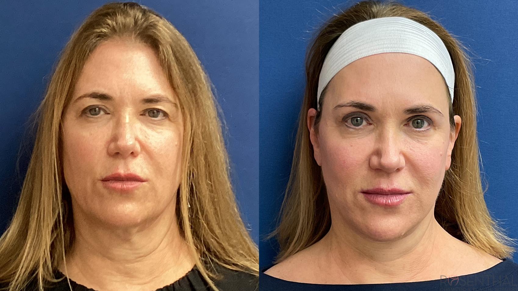Before & After Facelift Case 36 Front View in Boynton Beach, West Palm Beach, FL