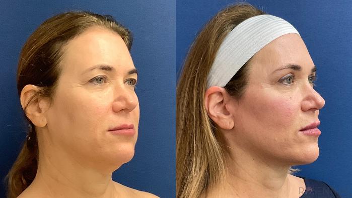 Before & After Facelift Case 36 Right Oblique View in Boynton Beach, West Palm Beach, FL