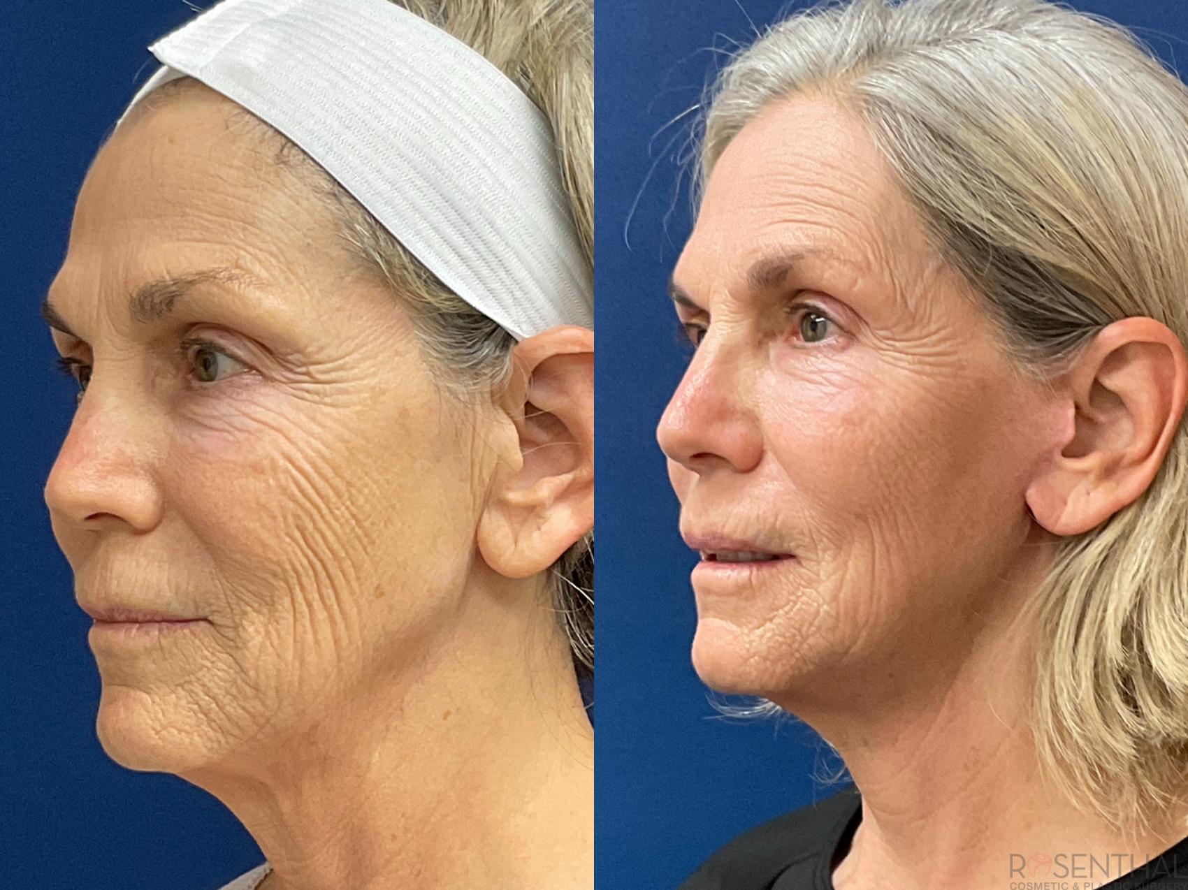 Before & After Facelift Case 37 Left Oblique View in Boynton Beach, West Palm Beach, FL