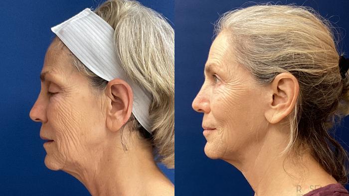 Before & After Facelift Case 37 Left Side View in Boynton Beach, West Palm Beach, FL