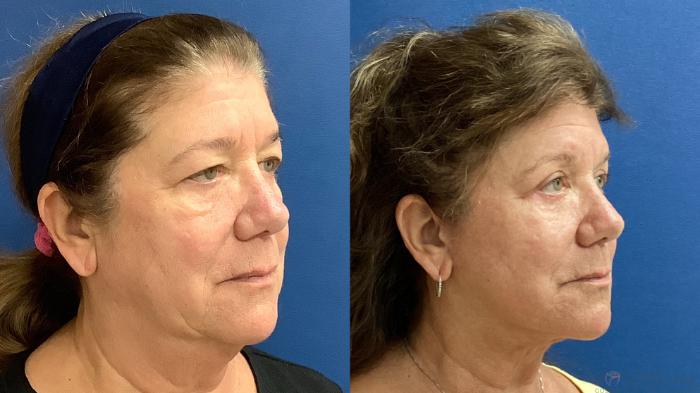 Before & After Facelift Case 69 Right Oblique View in Boynton Beach, West Palm Beach, FL