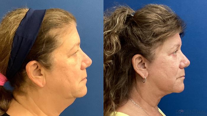 Before & After Facelift Case 69 Right Side View in Boynton Beach, West Palm Beach, FL