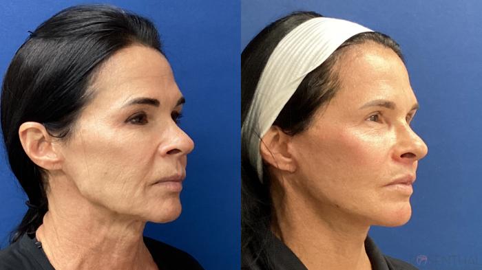 Before & After Facelift Case 82 Right Oblique View in Boynton Beach, West Palm Beach, FL