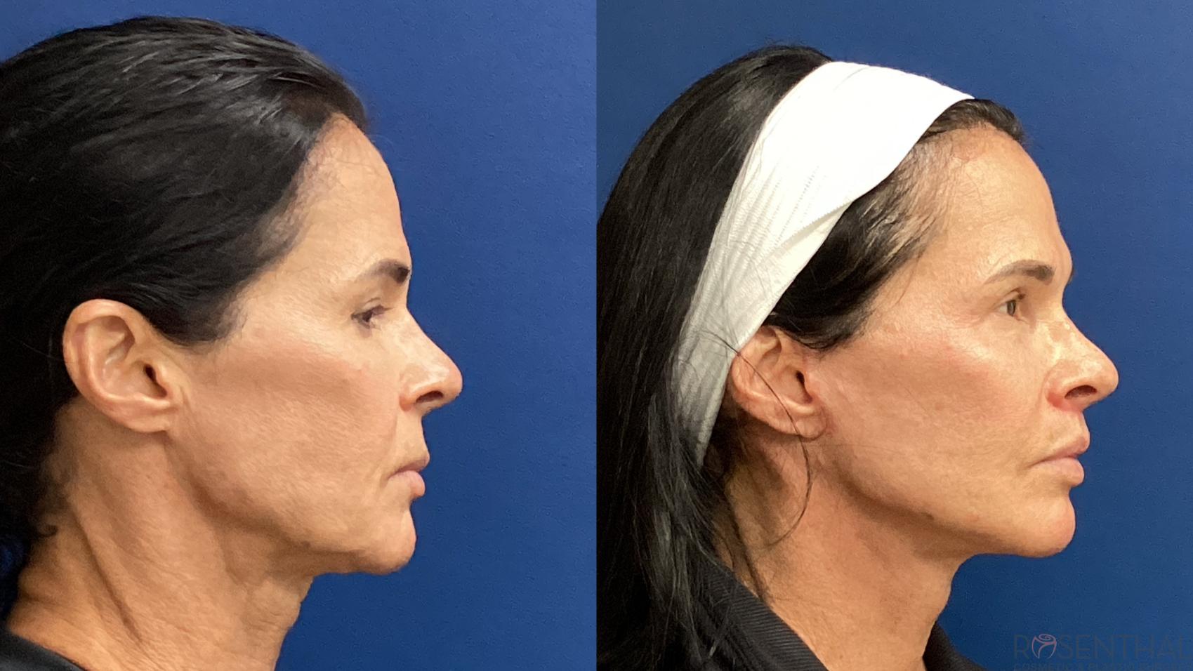 Before & After Facelift Case 82 Right Side View in Boynton Beach, West Palm Beach, FL