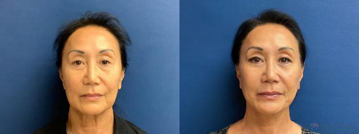 Before & After Facelift Case 84 Front View in Boynton Beach, West Palm Beach, FL