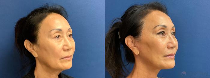 Before & After Facelift Case 84 Right Oblique View in Boynton Beach, West Palm Beach, FL