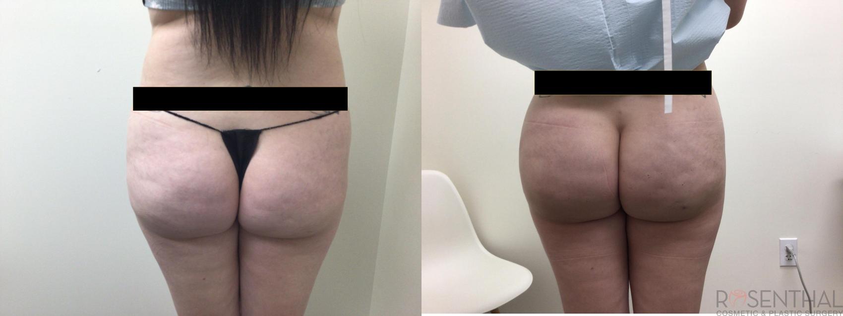 Before & After Liposuction Case 22 Back View in Boynton Beach, FL