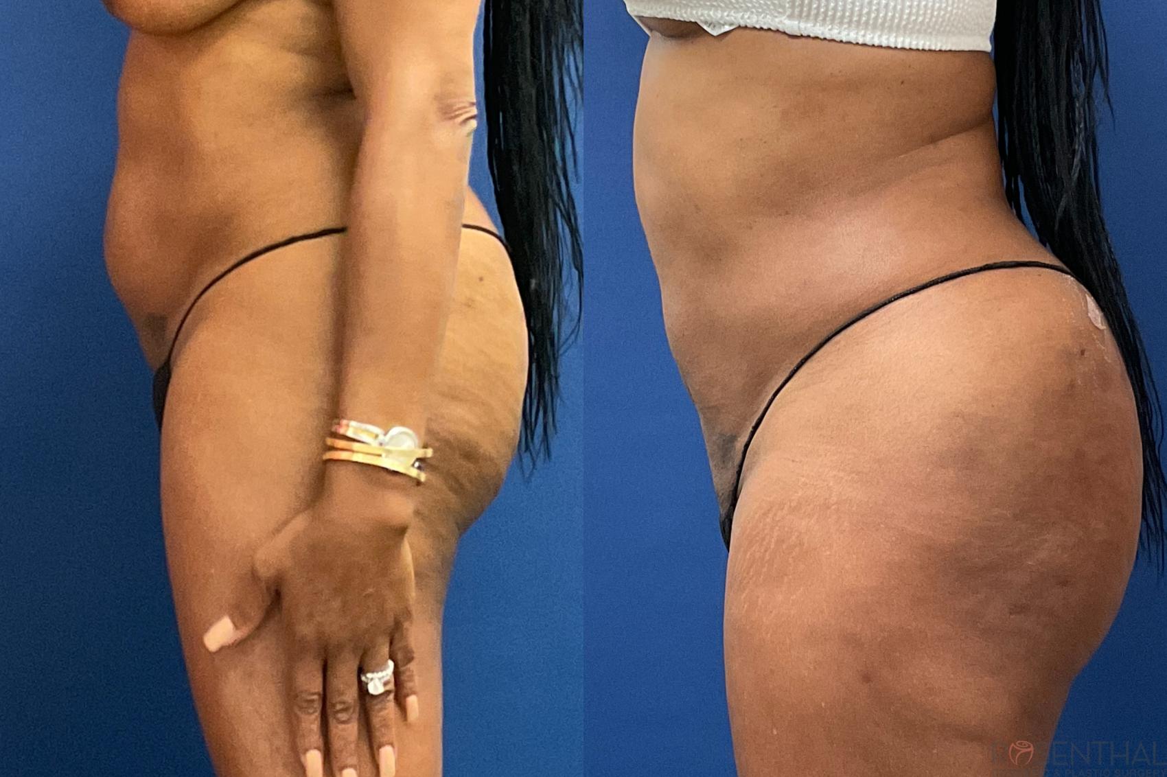 Before & After Liposuction Case 57 Left Side View in Boynton Beach, West Palm Beach, FL