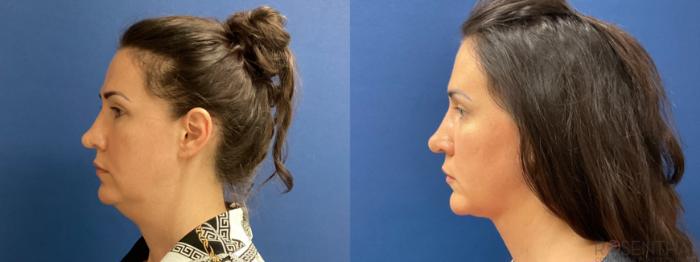 Before & After Liposuction Case 58 Left Side View in Boynton Beach, West Palm Beach, FL