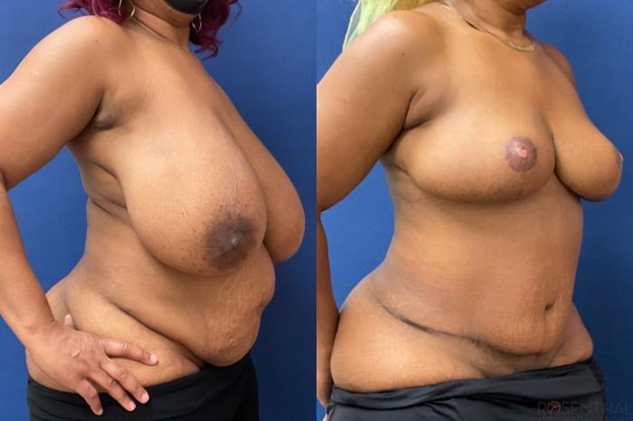 Before & After Mommy Makeover Case 17 Left Oblique View in Boynton Beach, FL