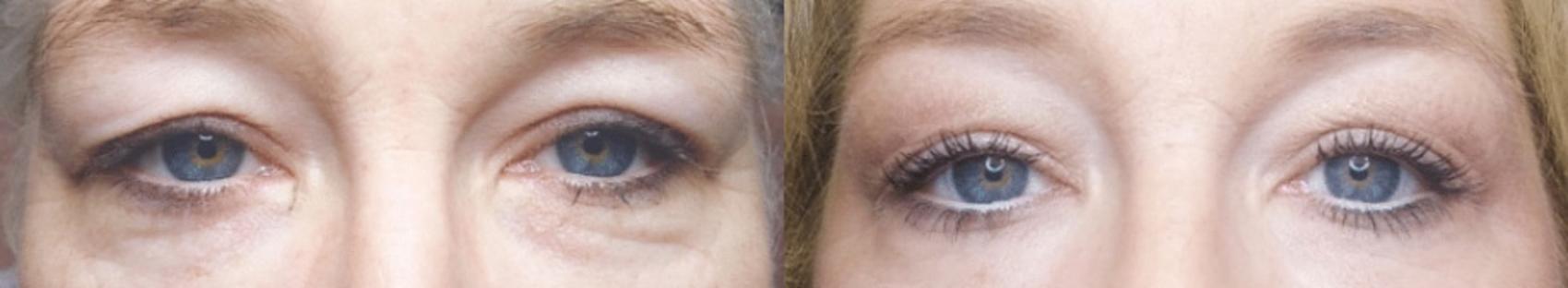 Before & After Non-Surgical Blepharoplasty Case 5 Front View in Boynton Beach, FL