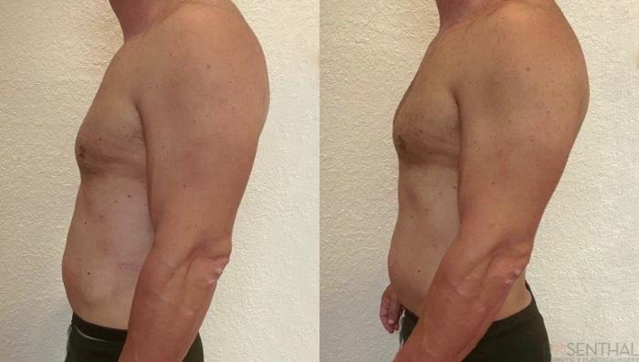 Body Contouring for Men Before and After Photo Gallery