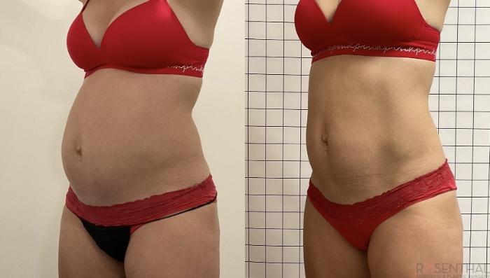 PHYSIQ Body Contouring Before and After Photo Gallery