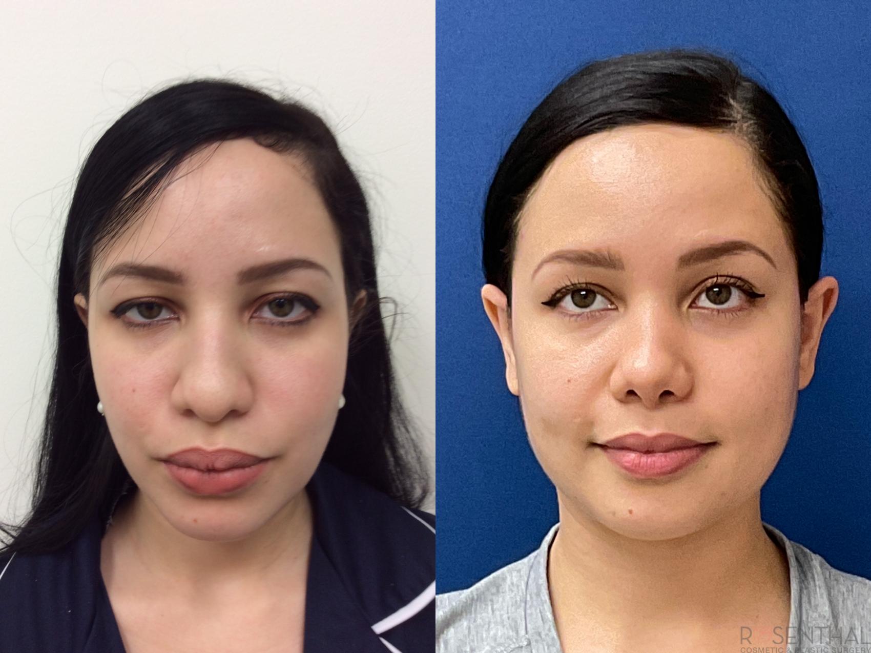 Before & After Rhinoplasty Case 11 Front View in Boynton Beach, FL