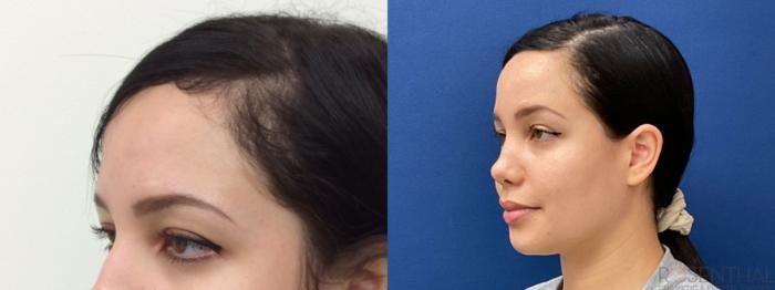 Before & After Rhinoplasty Case 11 Left Oblique View in Boynton Beach, West Palm Beach, FL