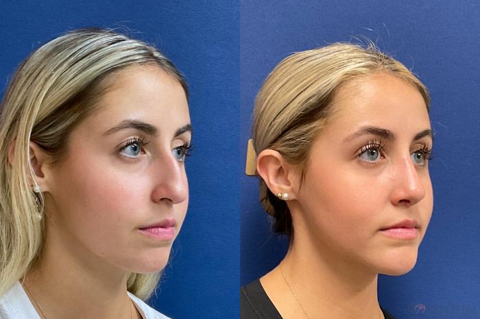 Before & After Rhinoplasty Case 38 Right Oblique View in Boynton Beach, West Palm Beach, FL