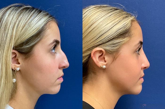 Before & After Rhinoplasty Case 38 Right Side View in Boynton Beach, West Palm Beach, FL