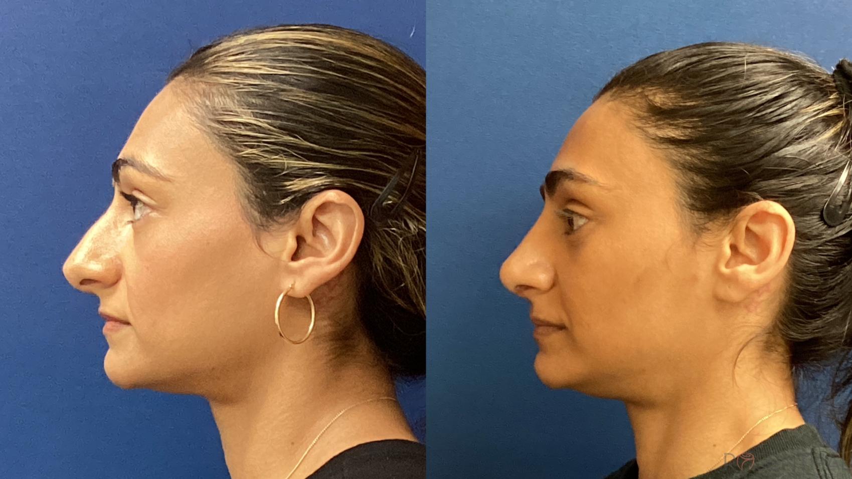 Before & After Rhinoplasty Case 39 Left Side View in Boynton Beach, West Palm Beach, FL