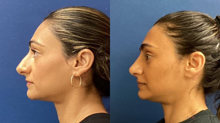 Before & After Rhinoplasty Case 39 Left Side View in Boynton Beach, West Palm Beach, FL