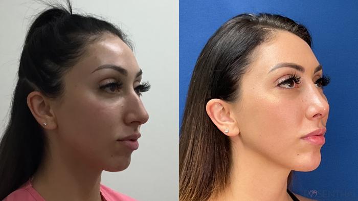 Before & After Rhinoplasty Case 40 Right Oblique View in Boynton Beach, West Palm Beach, FL