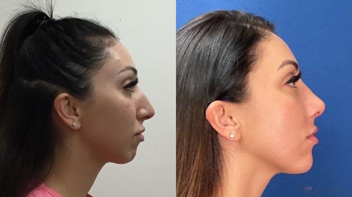 Before & After Rhinoplasty Case 40 Right Side View in Boynton Beach, West Palm Beach, FL