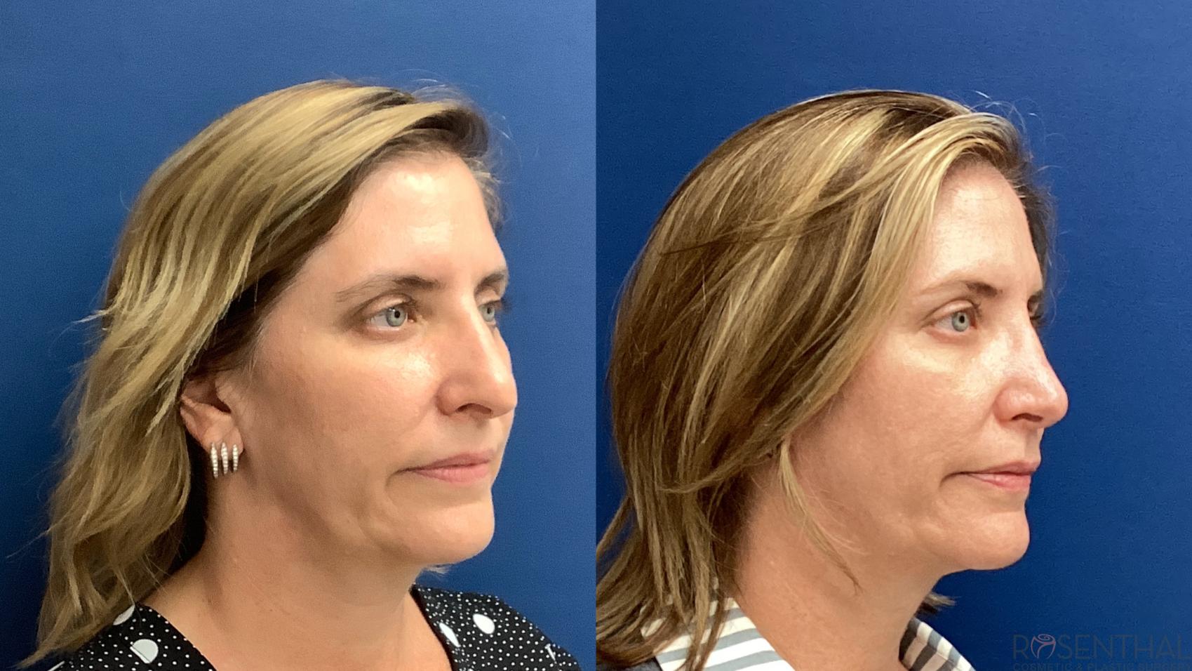 Before & After Rhinoplasty Case 70 Right Oblique View in Boynton Beach, West Palm Beach, FL