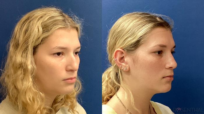 Before & After Rhinoplasty Case 79 Right Oblique View in Boynton Beach, West Palm Beach, FL