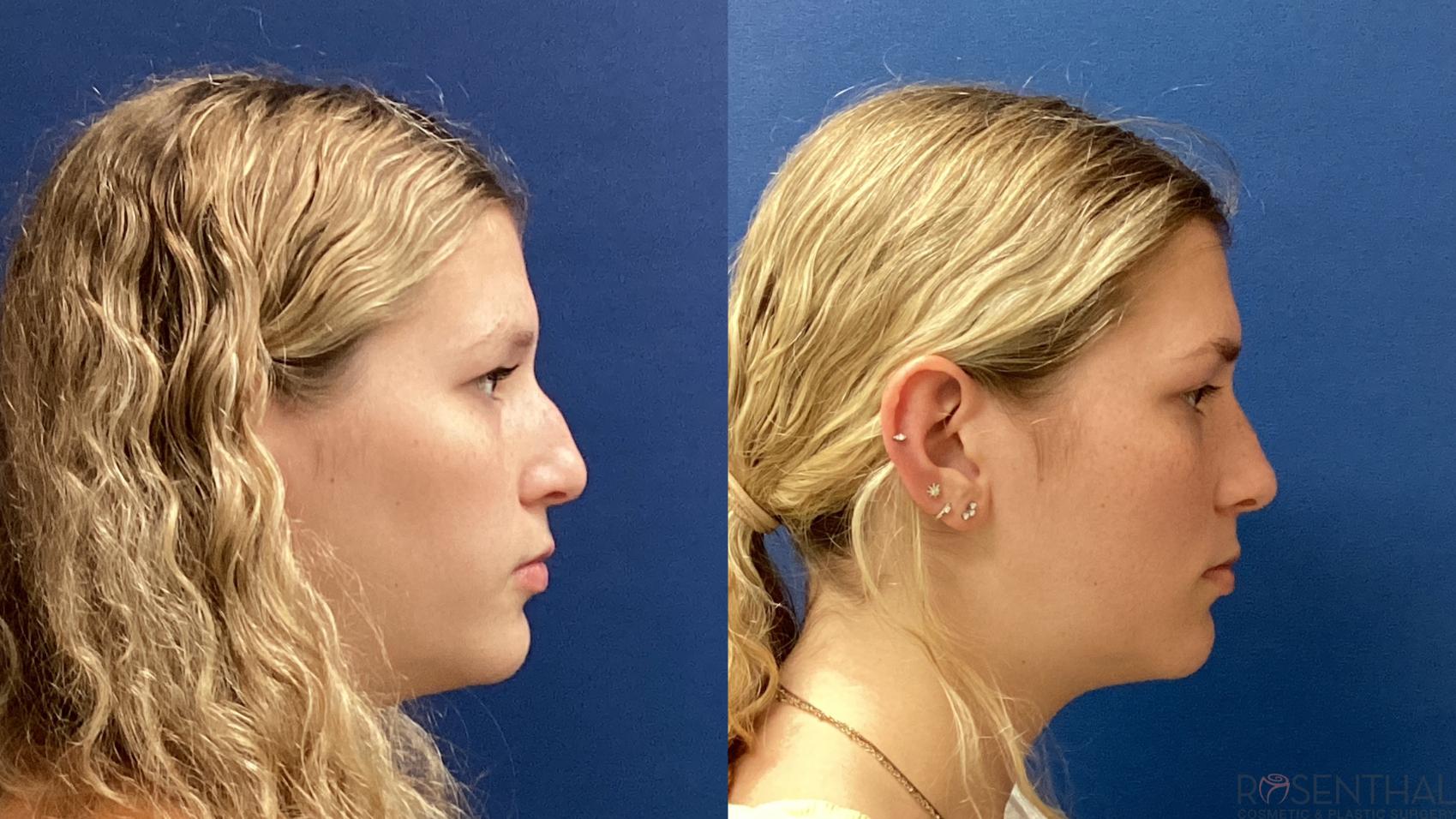 Before & After Rhinoplasty Case 79 Right Side View in Boynton Beach, West Palm Beach, FL