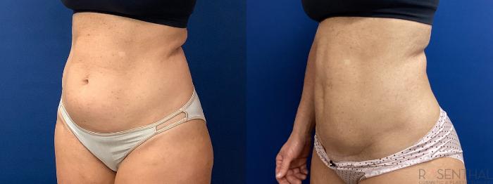 Before & After Tummy Tuck Case 60 Left Oblique View in Boynton Beach, West Palm Beach, FL