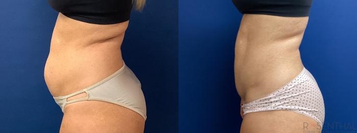 Before & After Tummy Tuck Case 60 Left Side View in Boynton Beach, West Palm Beach, FL